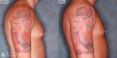 Gynecomastia Surgery Before & After Gallery - Patient 822707 - Image 1