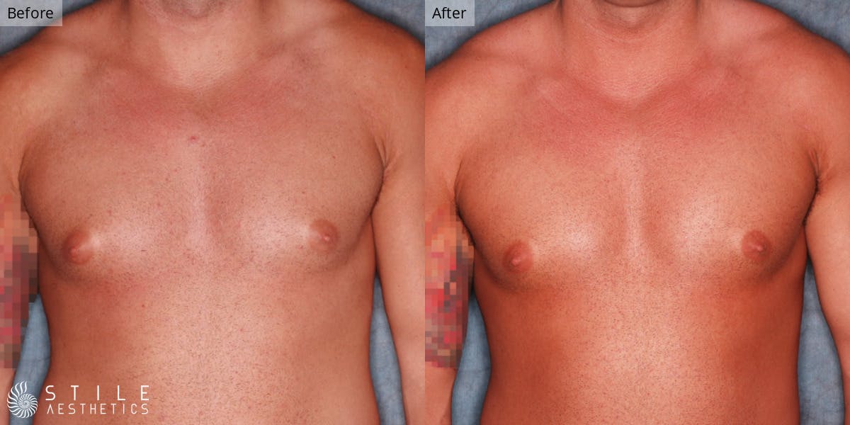Gynecomastia Surgery Before & After Gallery - Patient 822707 - Image 2