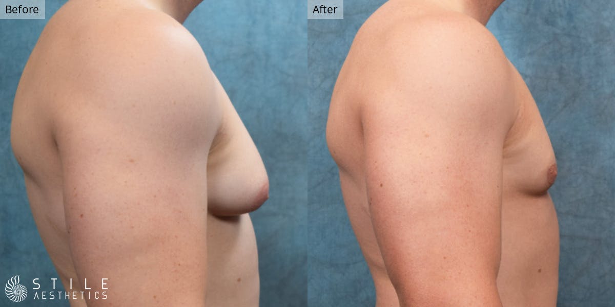 Gynecomastia Surgery Before & After Gallery - Patient 212732 - Image 1