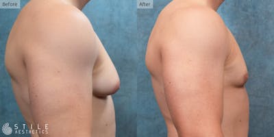 Gynecomastia Surgery Before & After Gallery - Patient 212732 - Image 1