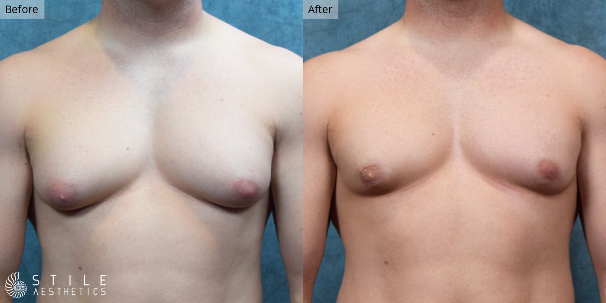 Gynecomastia Surgery Before & After Gallery - Patient 212732 - Image 2