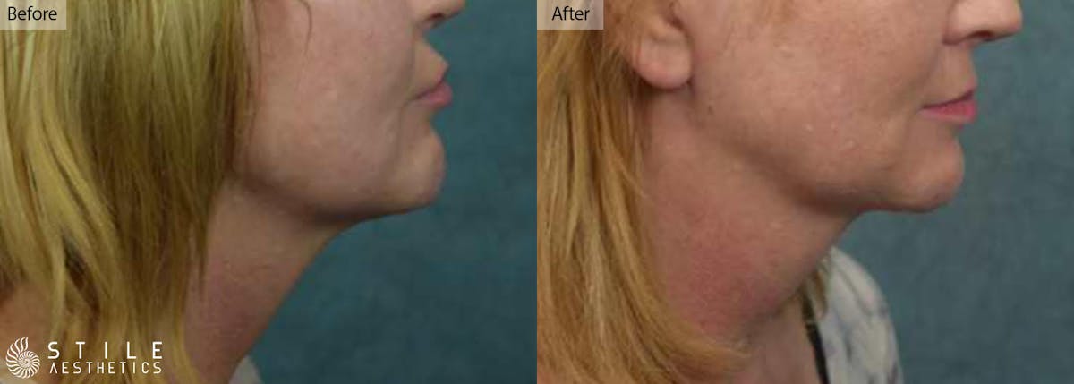 Chin Augmentation Before & After Gallery - Patient 107190 - Image 1