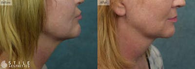 Chin Augmentation Before & After Gallery - Patient 107190 - Image 1