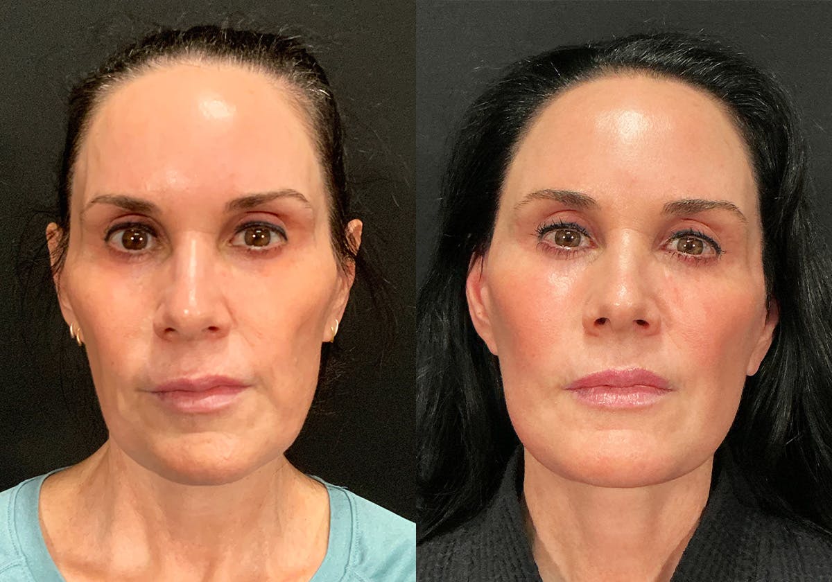 Facelift Before & After Gallery - Patient 308372 - Image 1