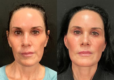 Facelift Before & After Gallery - Patient 308372 - Image 1