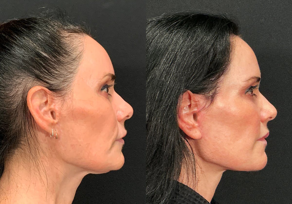 Facelift Before & After Gallery - Patient 308372 - Image 2
