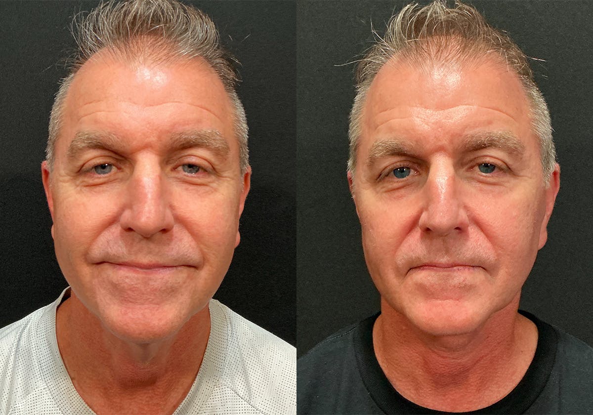 Facelift Before & After Gallery - Patient 103833 - Image 1
