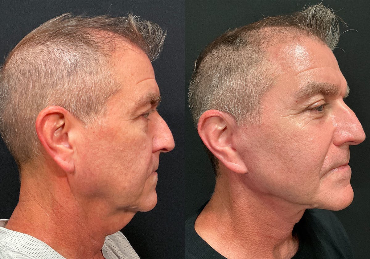 Facelift Before & After Gallery - Patient 103833 - Image 2