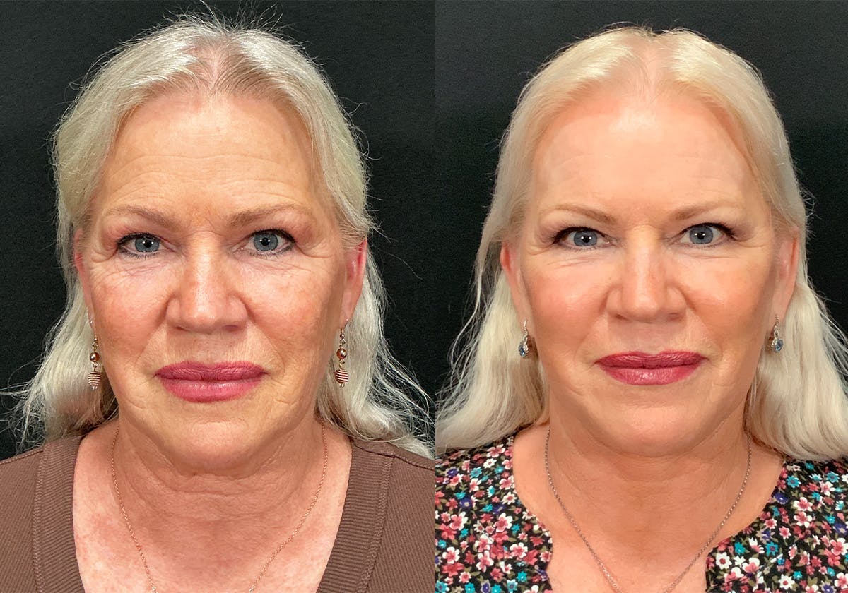 Facelift Before & After Gallery - Patient 401735 - Image 1
