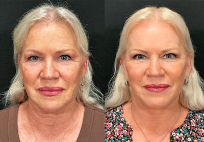 Facelift Before & After Gallery - Patient 401735 - Image 1