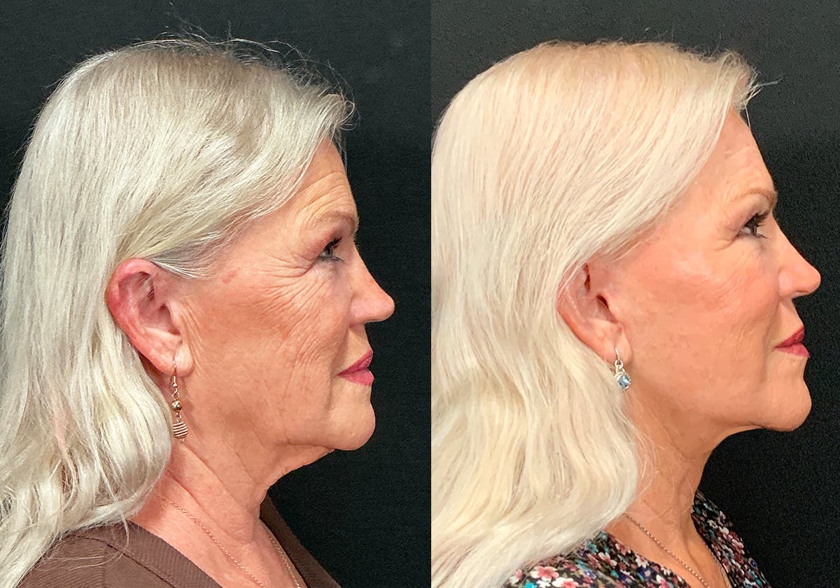 Facelift Before & After Gallery - Patient 401735 - Image 2