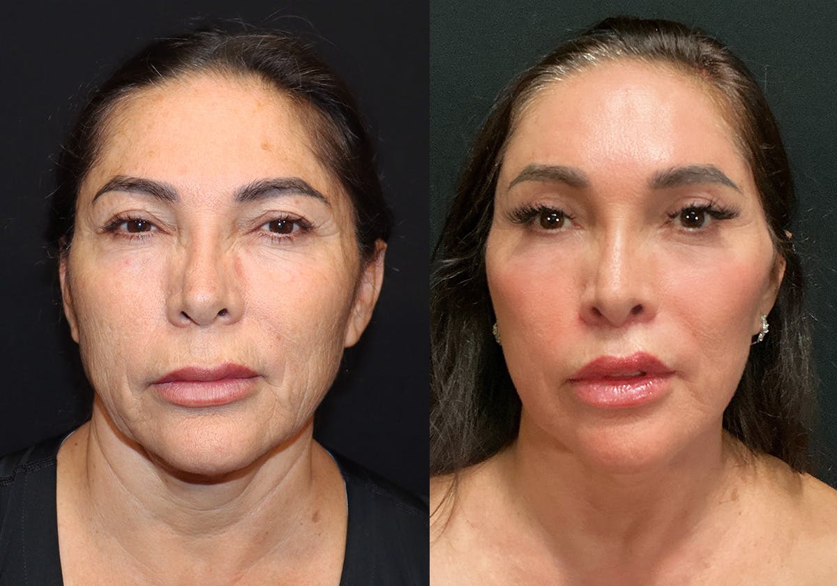 Facelift Before & After Gallery - Patient 124352 - Image 1