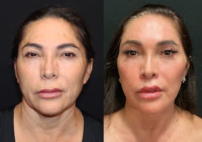 Facelift Before & After Gallery - Patient 124352 - Image 1