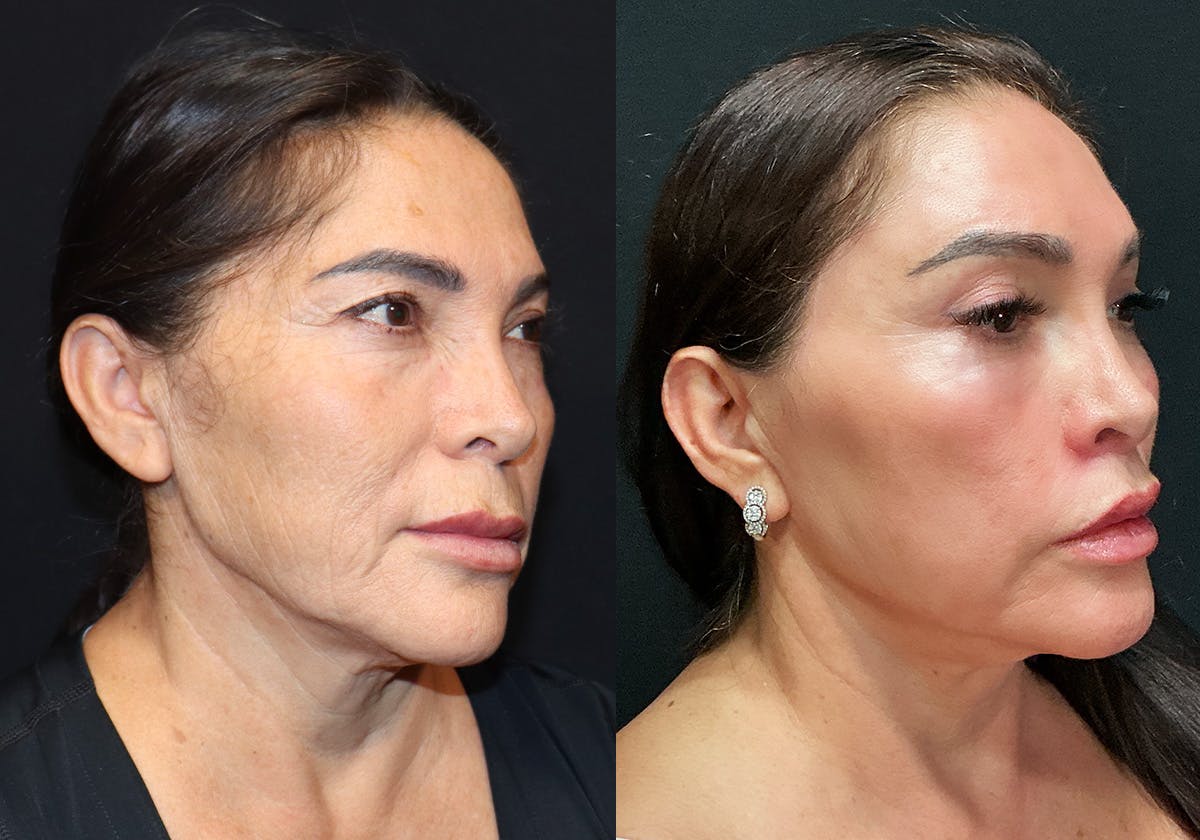 Facelift Before & After Gallery - Patient 124352 - Image 2