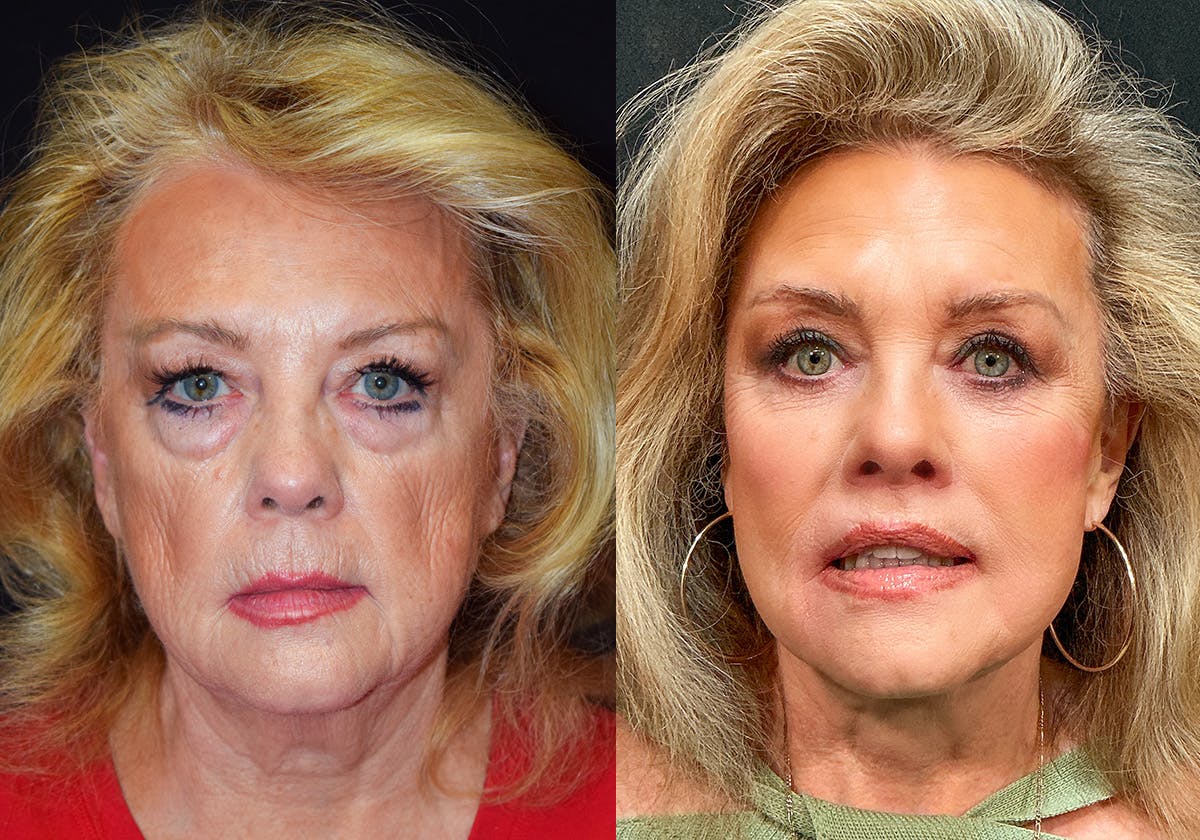 Facelift Before & After Gallery - Patient 201962 - Image 1