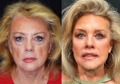 Facelift Before & After Gallery - Patient 201962 - Image 1