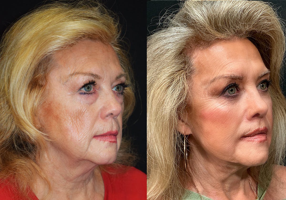 Facelift Before & After Gallery - Patient 201962 - Image 2