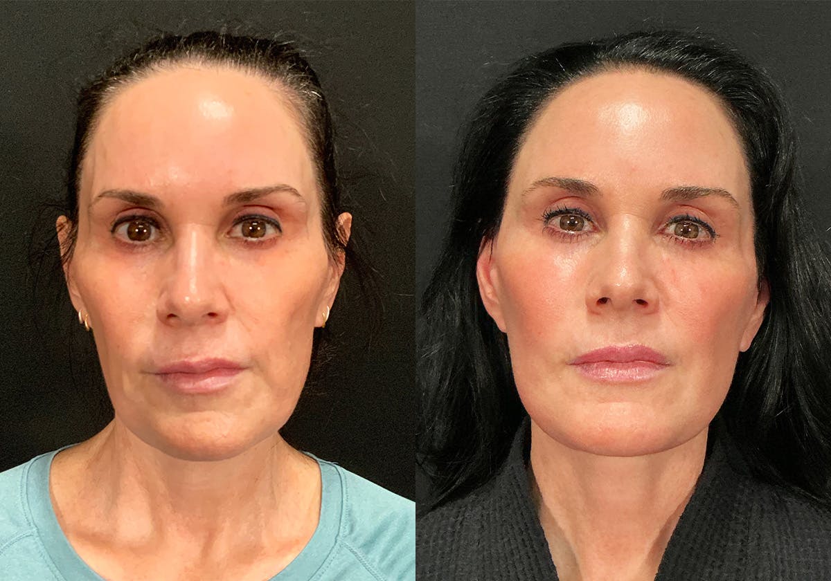Facelift Before & After Gallery - Patient 358925 - Image 1