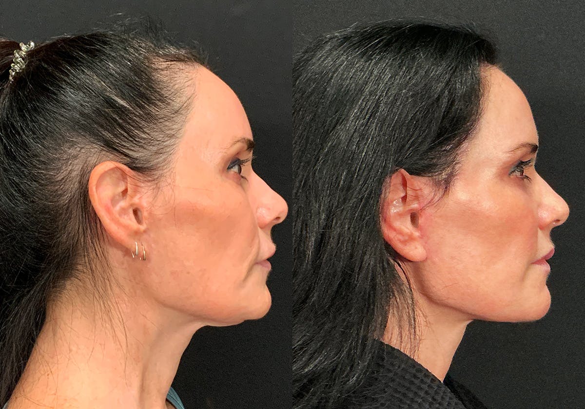 Facelift Before & After Gallery - Patient 358925 - Image 2