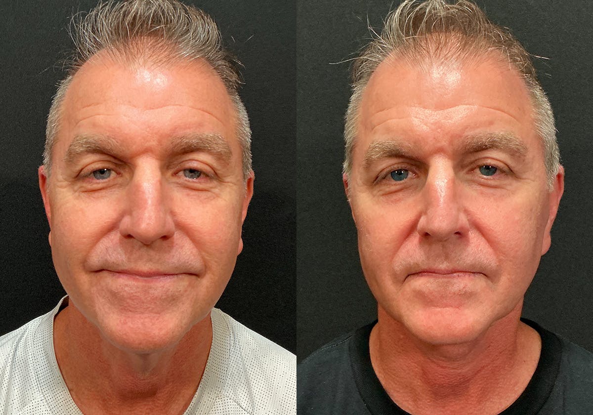 Facelift Before & After Gallery - Patient 369977 - Image 1