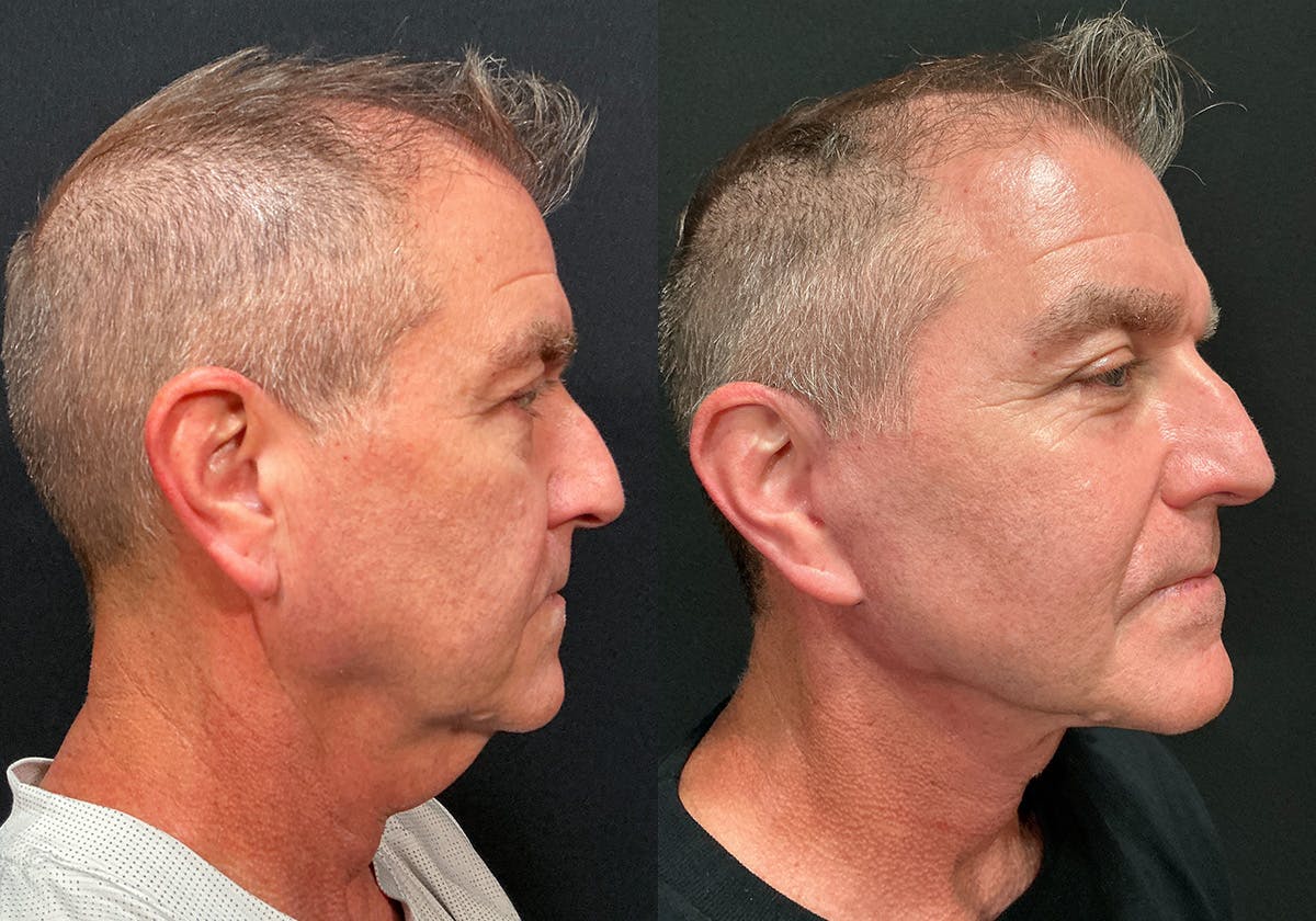 Facelift Before & After Gallery - Patient 369977 - Image 2