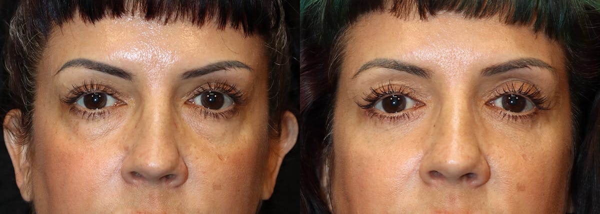 Lower Eyelid Surgery Before & After Gallery - Patient 225704 - Image 1