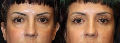 Lower Eyelid Surgery Before & After Gallery - Patient 225704 - Image 1