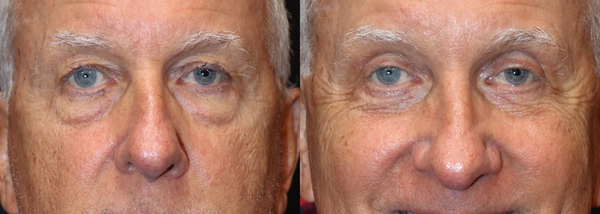 Lower Eyelid Surgery Before & After Gallery - Patient 771480 - Image 1