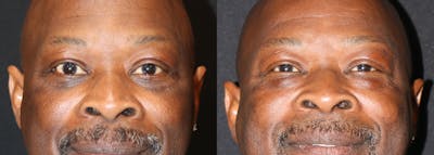 Lower Eyelid Surgery Before & After Gallery - Patient 274540 - Image 1
