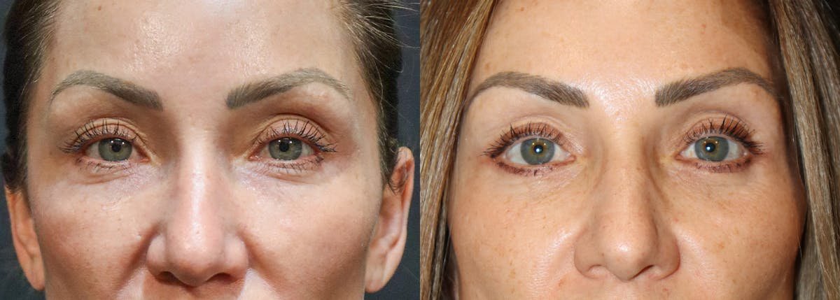 Lower Eyelid Surgery Before & After Gallery - Patient 215994 - Image 1