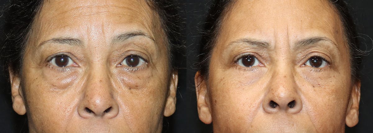 Lower Eyelid Surgery Before & After Gallery - Patient 953196 - Image 1