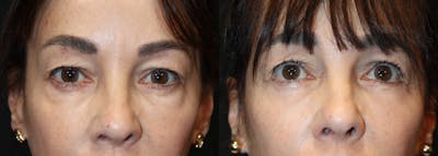 Lower Eyelid Surgery Before & After Gallery - Patient 693050 - Image 1
