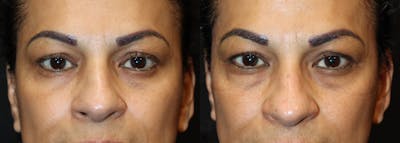 Lower Eyelid Surgery Before & After Gallery - Patient 254413 - Image 1