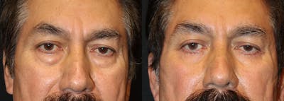 Lower Eyelid Surgery Before & After Gallery - Patient 140668 - Image 1