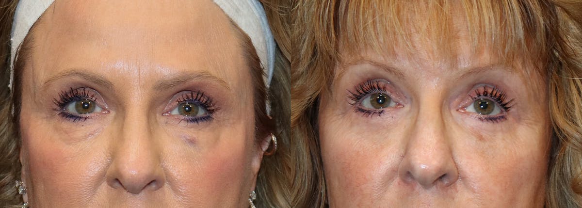 Lower Eyelid Surgery Before & After Gallery - Patient 389213 - Image 1