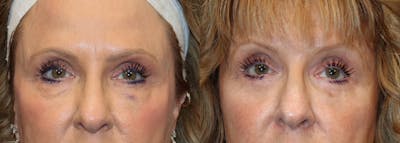 Lower Eyelid Surgery Before & After Gallery - Patient 389213 - Image 1
