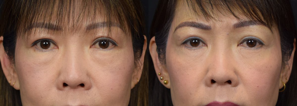 Lower Eyelid Surgery Before & After Gallery - Patient 170891 - Image 1