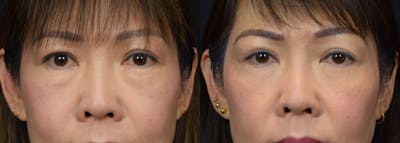 Lower Eyelid Surgery Before & After Gallery - Patient 170891 - Image 1