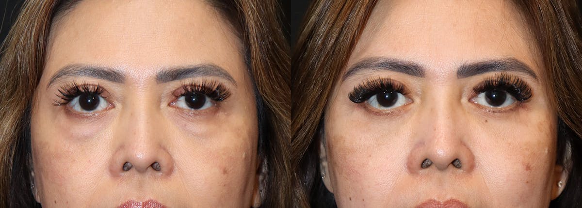 Lower Eyelid Surgery Before & After Gallery - Patient 254994 - Image 1