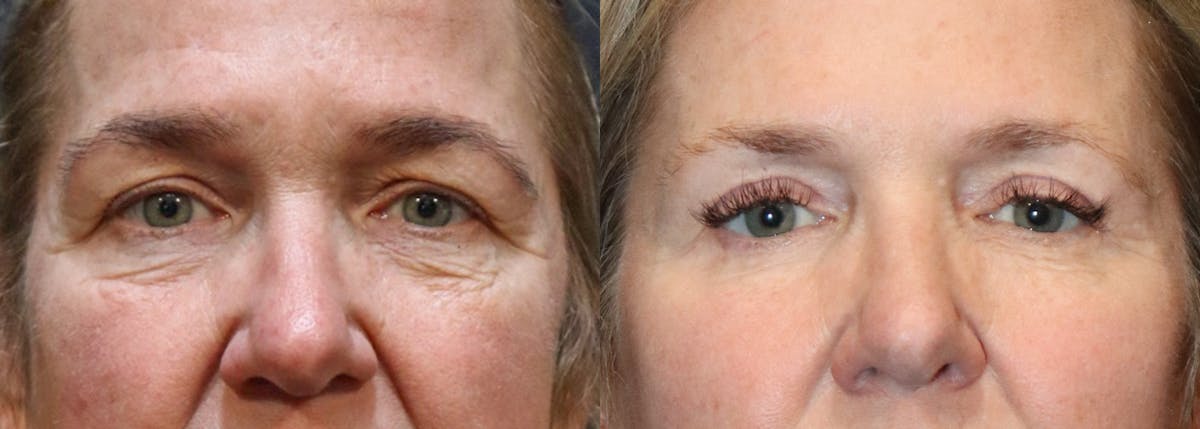 Lower Eyelid Surgery Before & After Gallery - Patient 387120 - Image 1