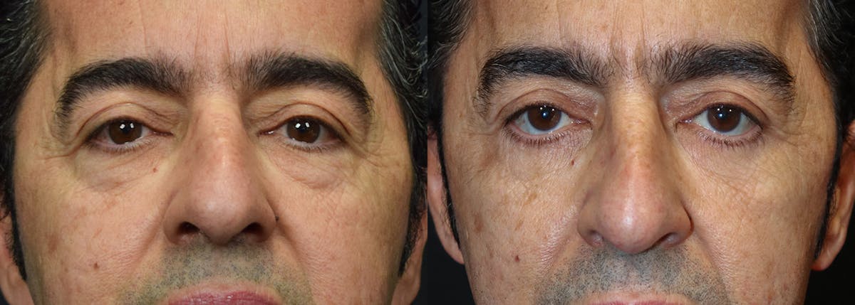 Lower Eyelid Surgery Before & After Gallery - Patient 256360 - Image 1