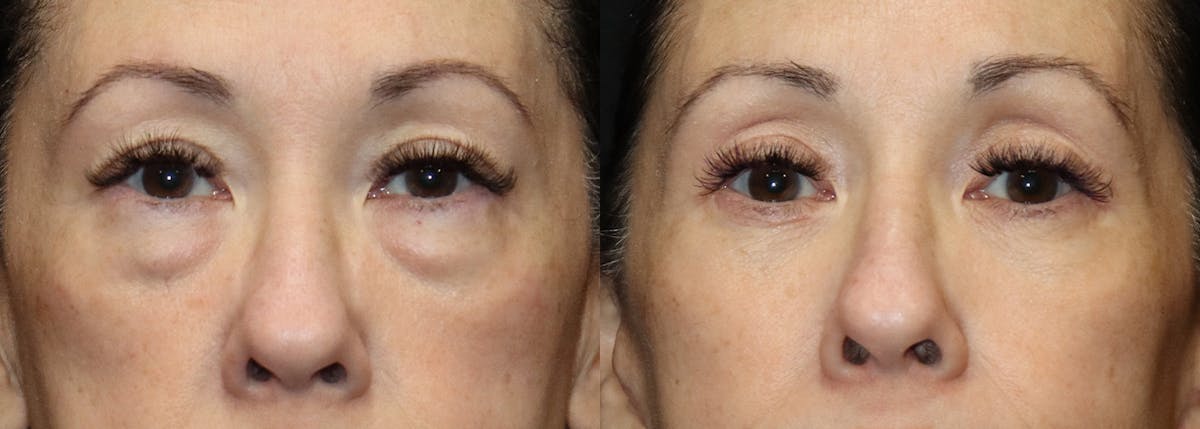 Lower Eyelid Surgery Before & After Gallery - Patient 364081 - Image 1