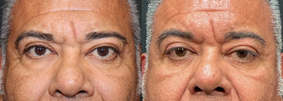 Lower Eyelid Surgery Before & After Gallery - Patient 303783 - Image 1