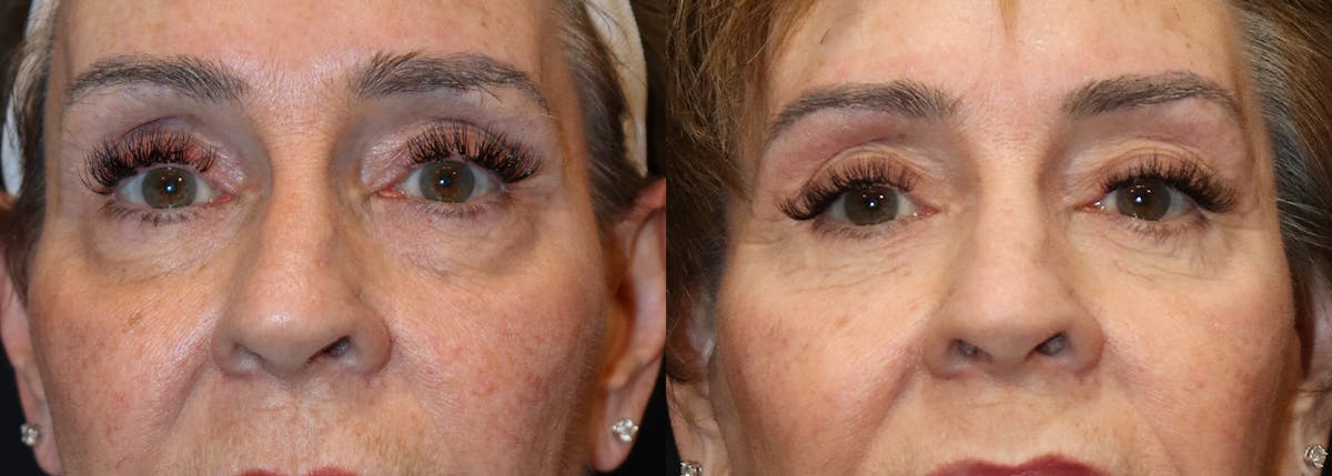 Lower Eyelid Surgery Before & After Gallery - Patient 275791 - Image 1