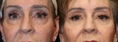 Lower Eyelid Surgery Before & After Gallery - Patient 275791 - Image 1