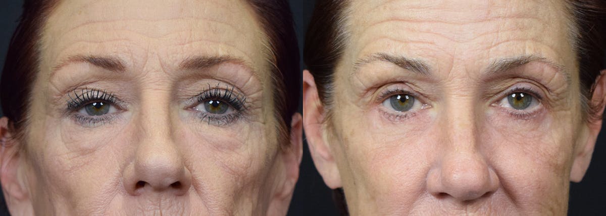 Lower Eyelid Surgery Before & After Gallery - Patient 324647 - Image 1