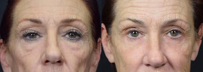 Lower Eyelid Surgery Before & After Gallery - Patient 324647 - Image 1