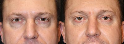 Lower Eyelid Surgery Before & After Gallery - Patient 414613 - Image 1