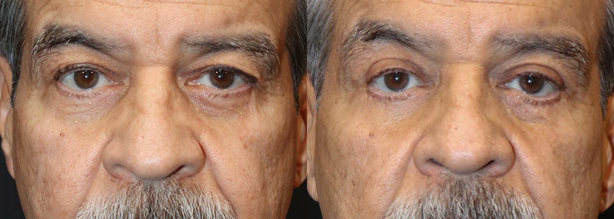 Lower Eyelid Surgery Before & After Gallery - Patient 117224 - Image 1