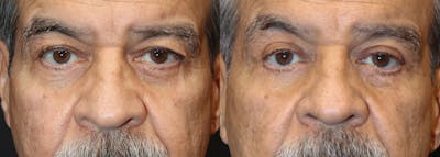 Lower Eyelid Surgery Before & After Gallery - Patient 117224 - Image 1